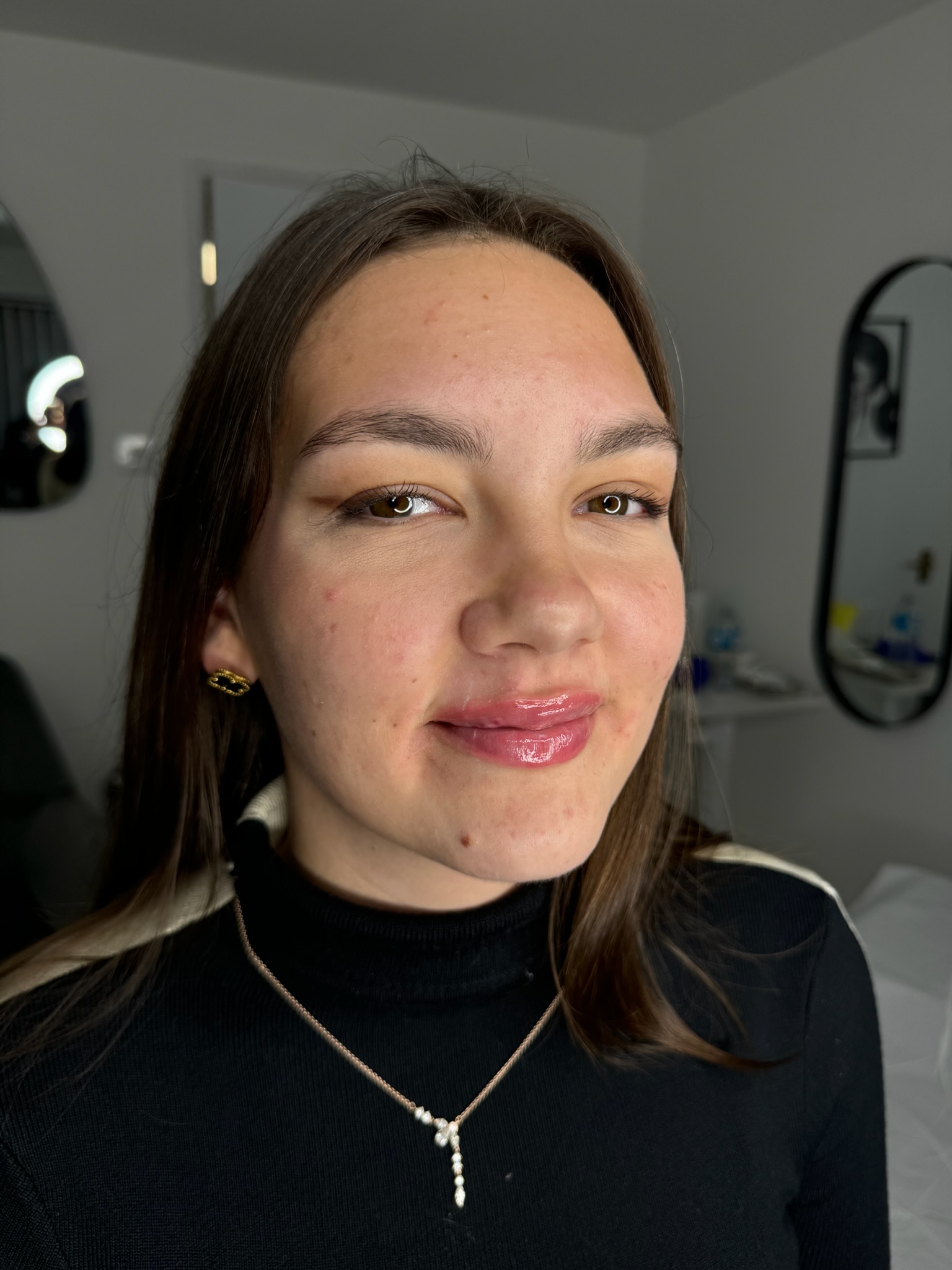 Acne Scarring