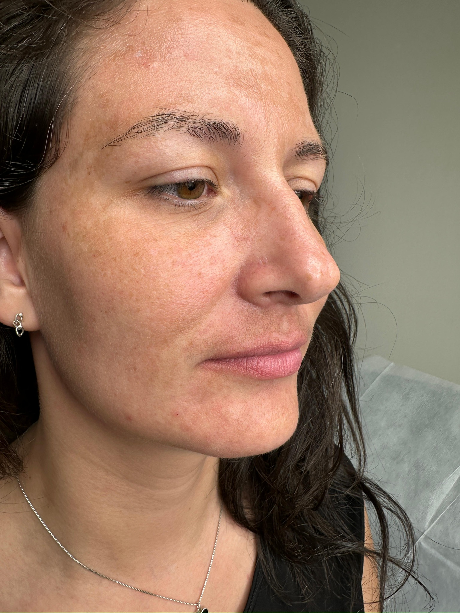Mid-Face Contour & Volume
