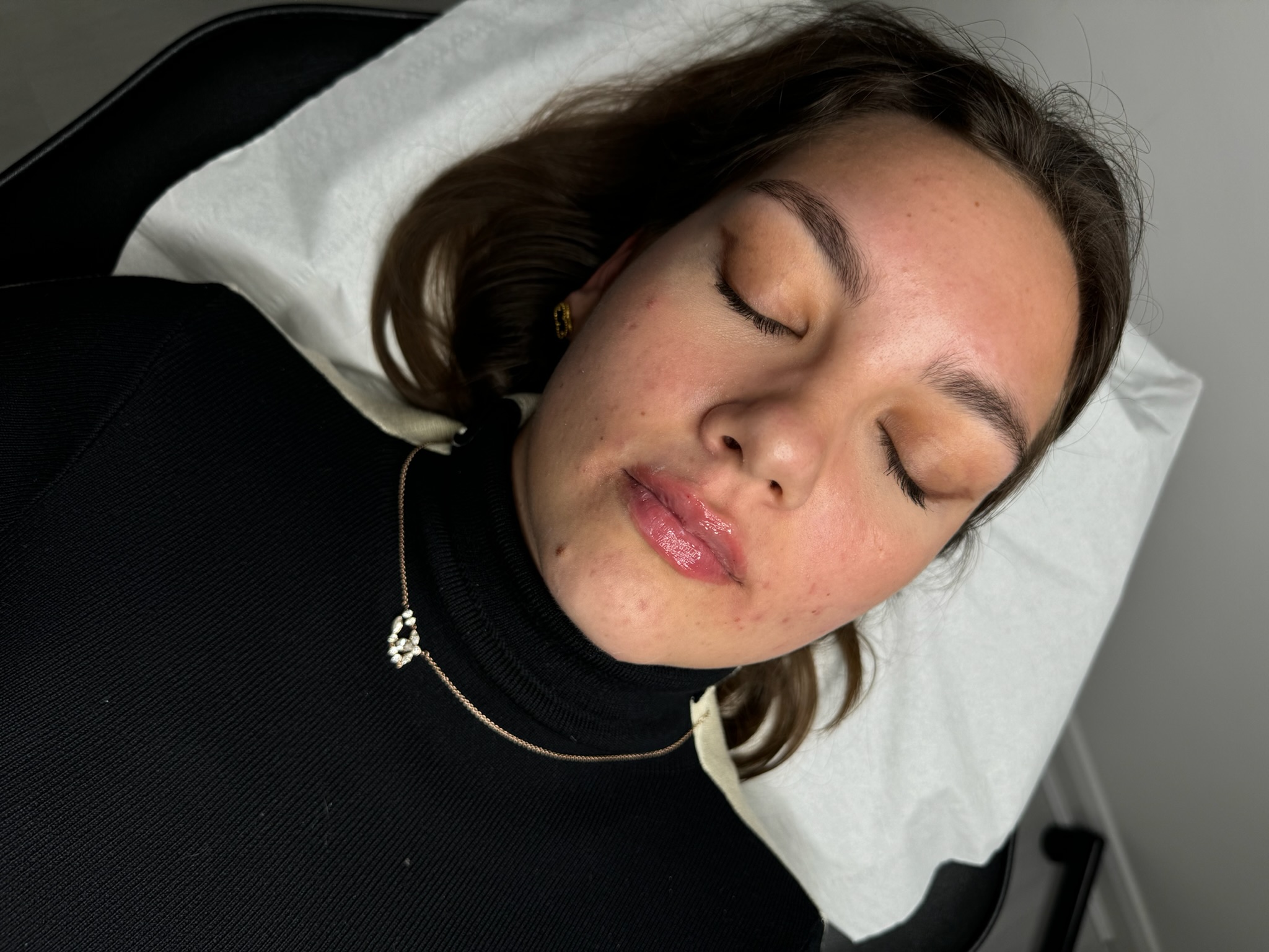 Lip filler