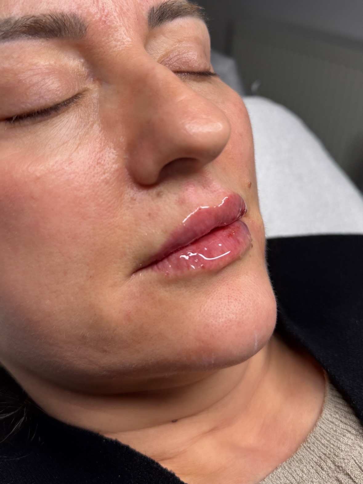Perioral Lines