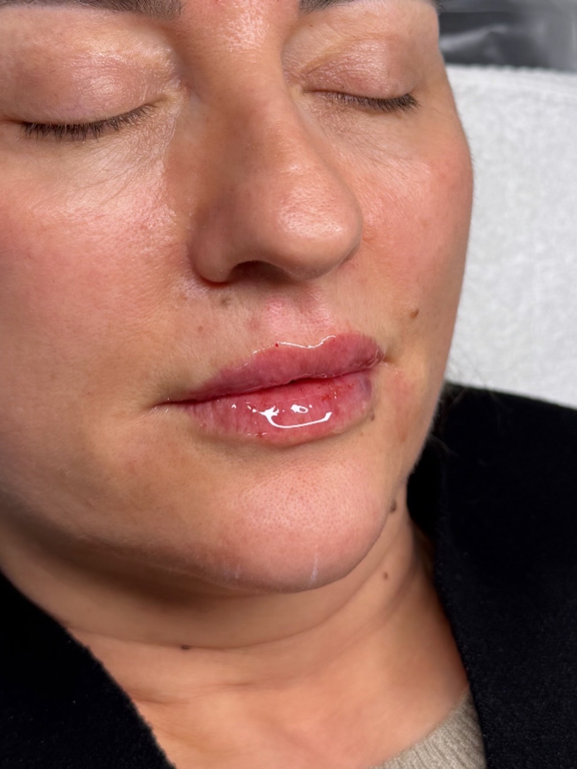 Lip treatment